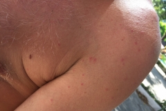 1994  16-1-18 rash