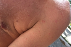 1995  16-1-18 rash